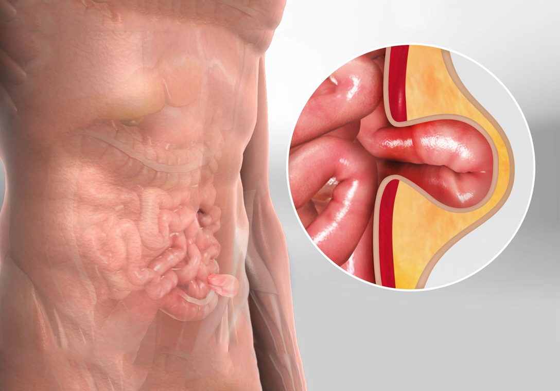 Hernia Repair Surgery