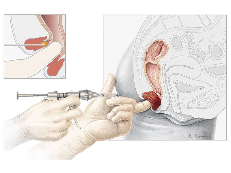  Anal incontinence surgery illustration